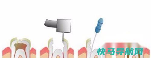 蛀牙根管治疗怎么回事？根管治疗流程 第3张