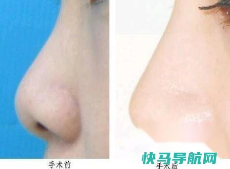 北京硅胶隆鼻哪个口碑好 第3张